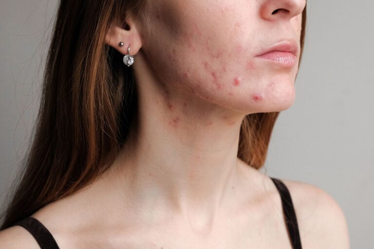 Acabe de vez com a acne hormonal: melhores óleos essenciais